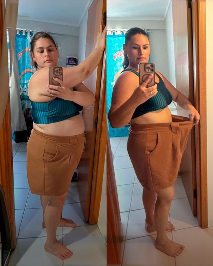 Antes e depois de paciente em emagrecimento e recomposição corporal